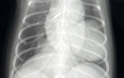 肺腫瘍（肺癌）の診断と治療